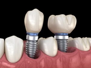 Dental Implants